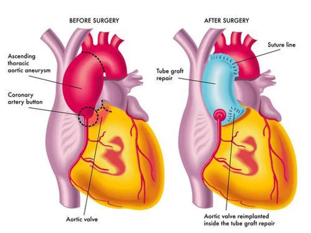 Pictures of ascending aorta