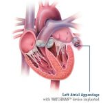 Pictures Of Atrial Appendage (auricle)
