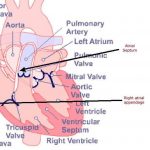 Pictures Of Atrial Appendage (auricle)