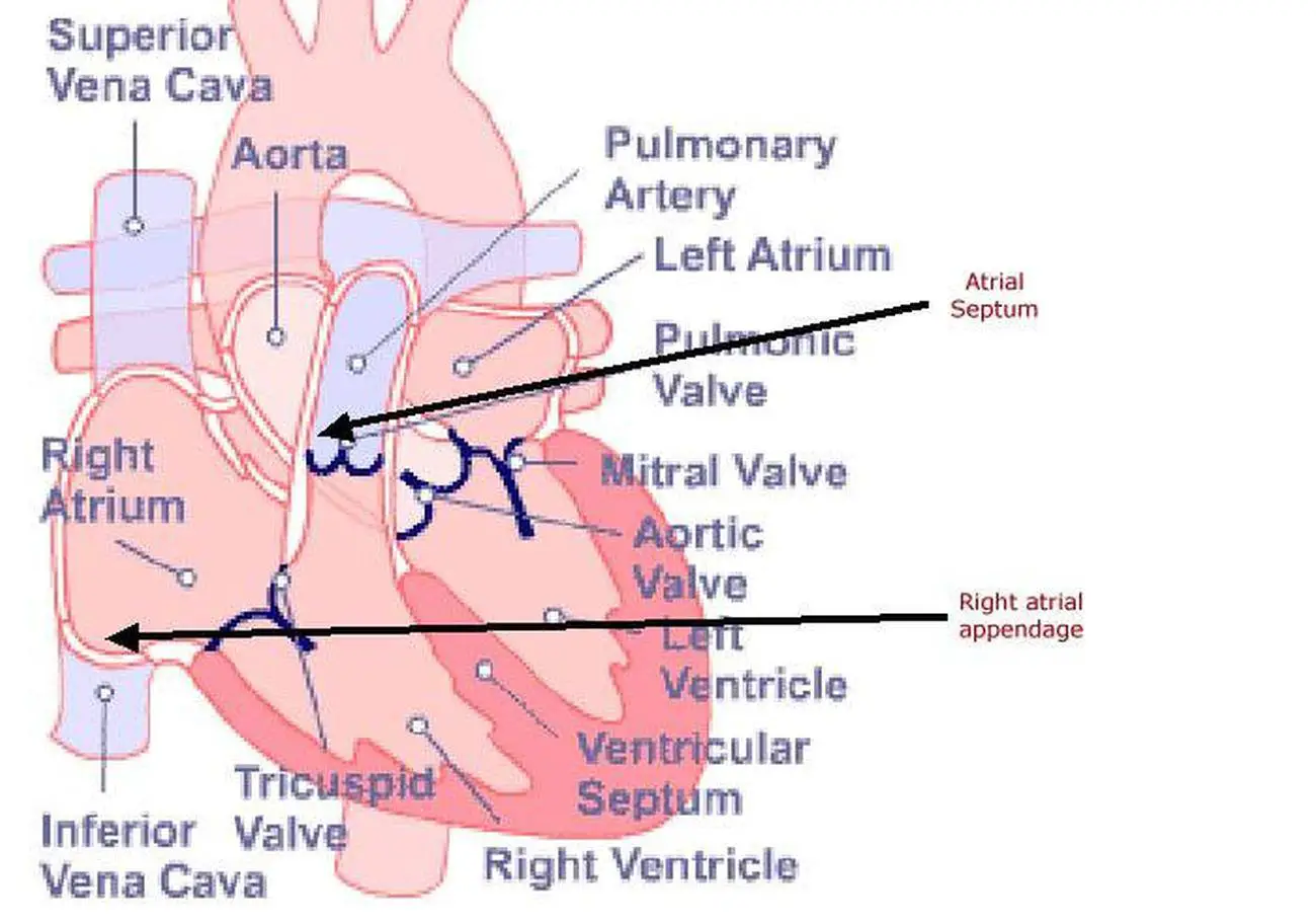 Pictures Of Atrial Appendage (auricle)
