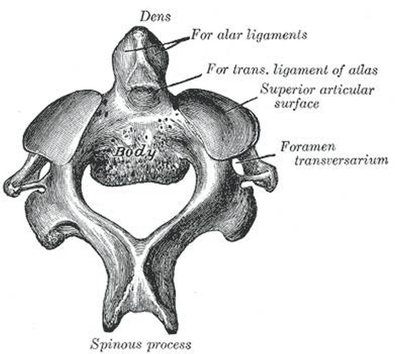 Pictures Of Axis Vertebra, Odontoid Process