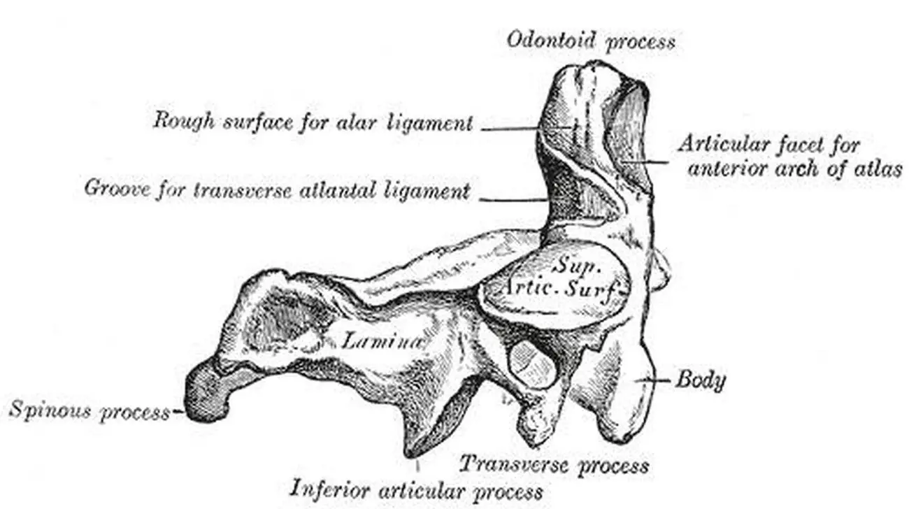 Pictures Of Axis Vertebra, Odontoid Process