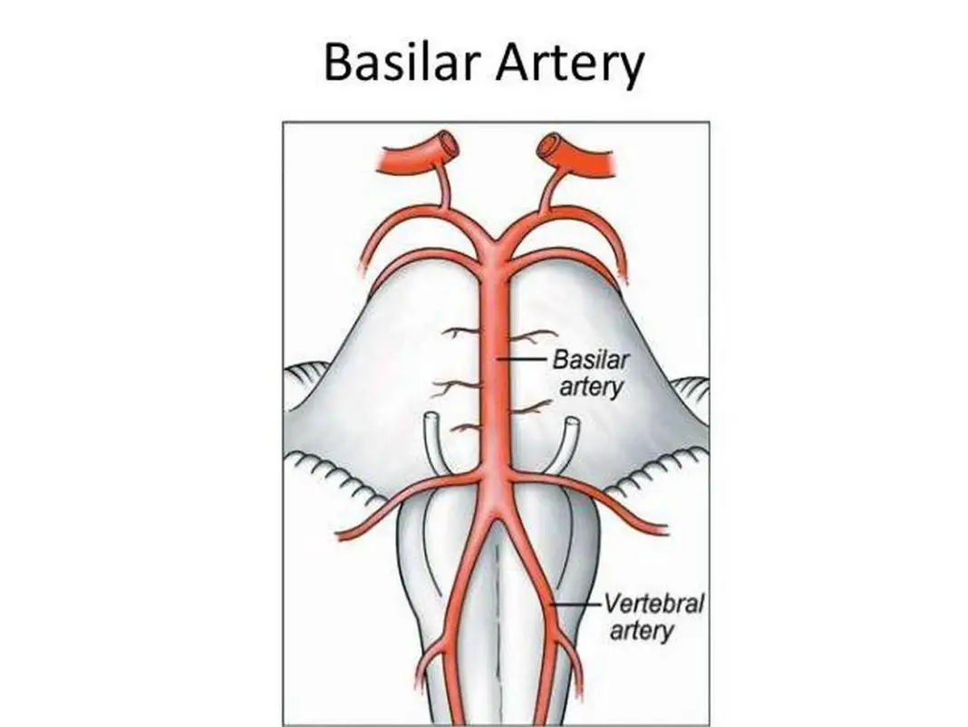 Pictures Of Basilar Artery