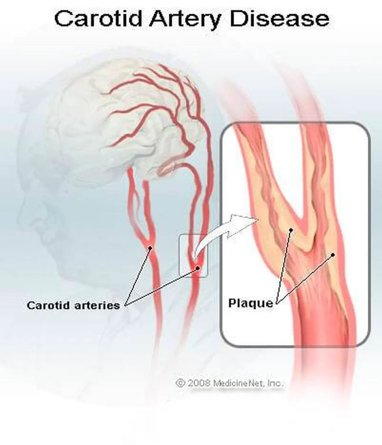 Pictures Of Carotid Arteries