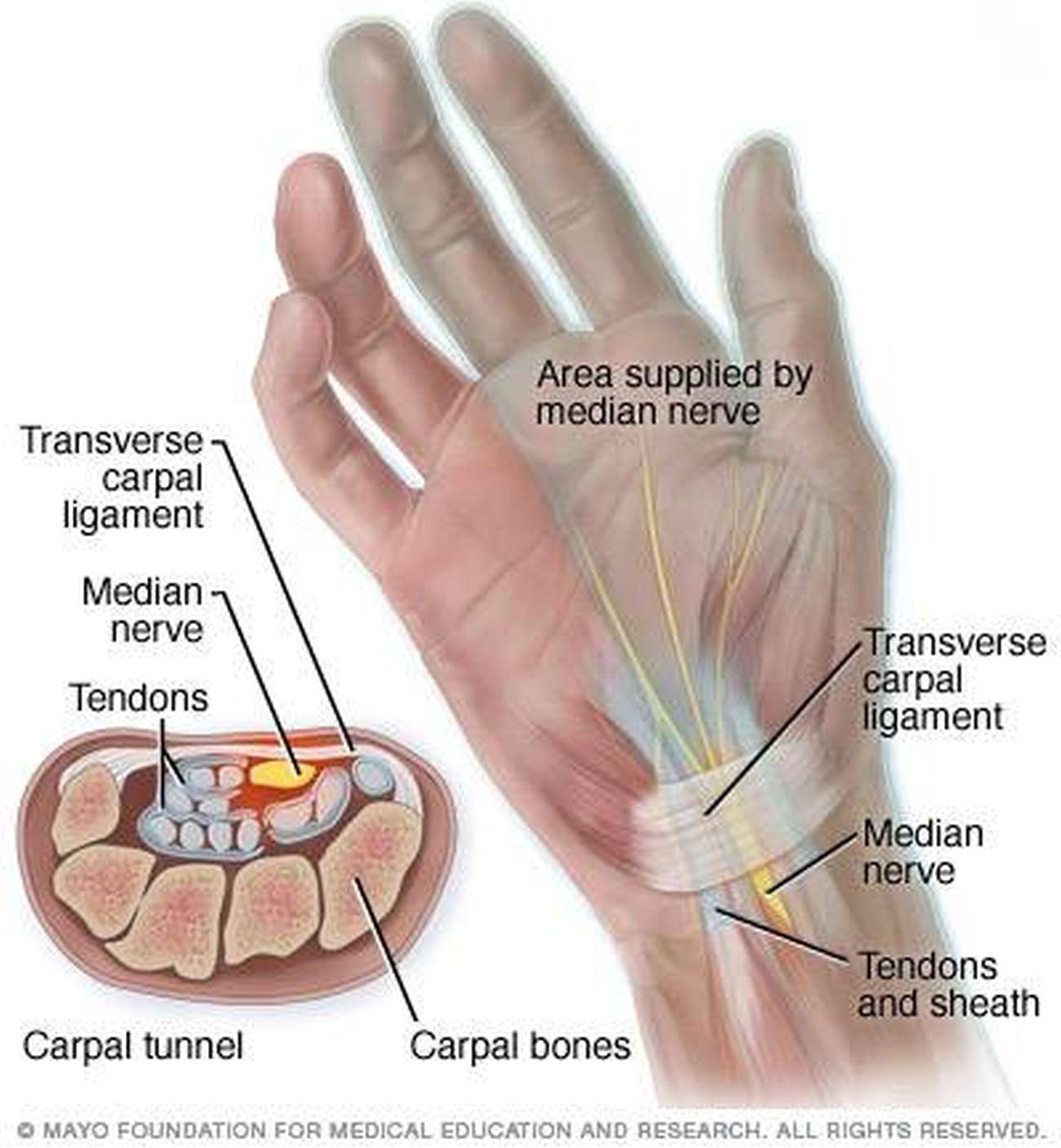 Pictures Of Carpal Tunnel