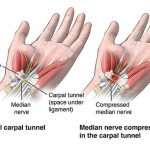 Pictures Of Carpal Tunnel