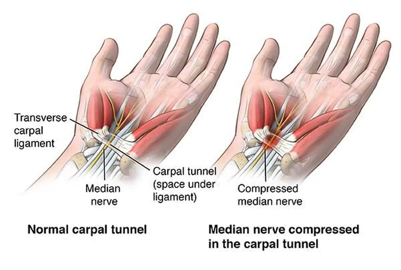 Pictures Of Carpal Tunnel