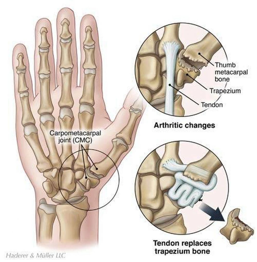 pictures-of-carpometacarpal-joints