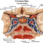 Pictures Of Cavernous Sinus