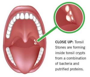 Tonsils diagram