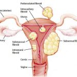 Uterus diagram