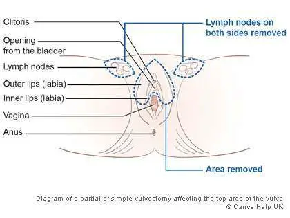 Vulva diagram