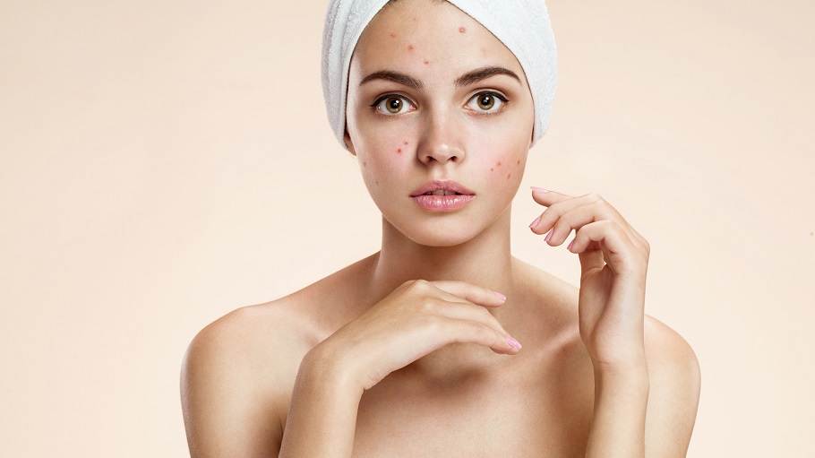 Acne Definition Causes Remedies