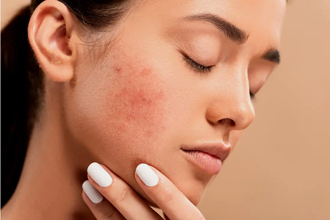 acne-skin-woman
