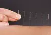 Acupuncture, Does It Really Help?
