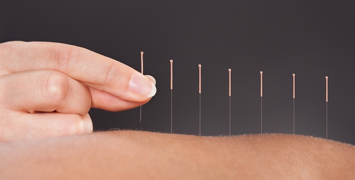 How to Choose the Best Acupuncturist