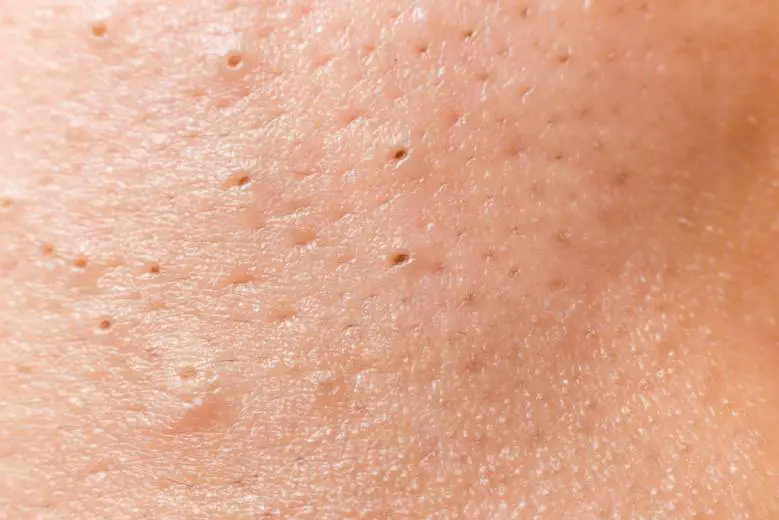 blackheads