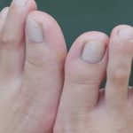 Signs of a Broken Toe