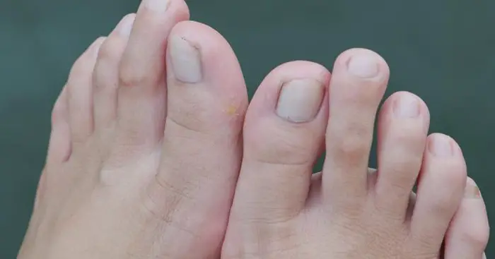 Signs of a Broken Toe