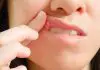 5 Easy Ways to Banish Your Canker Sore
