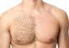 What Are Common Areas For Men For Laser Hair Removal?