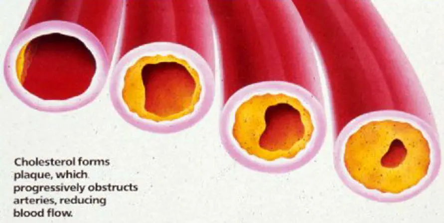 cholesterol22