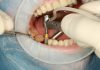 Understanding the Longevity of Teeth Implants: What to Expect