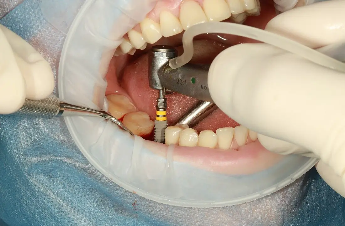 dental-implant