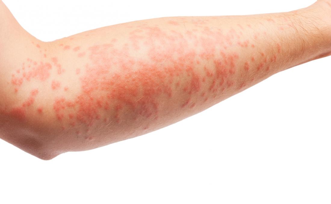 eczema