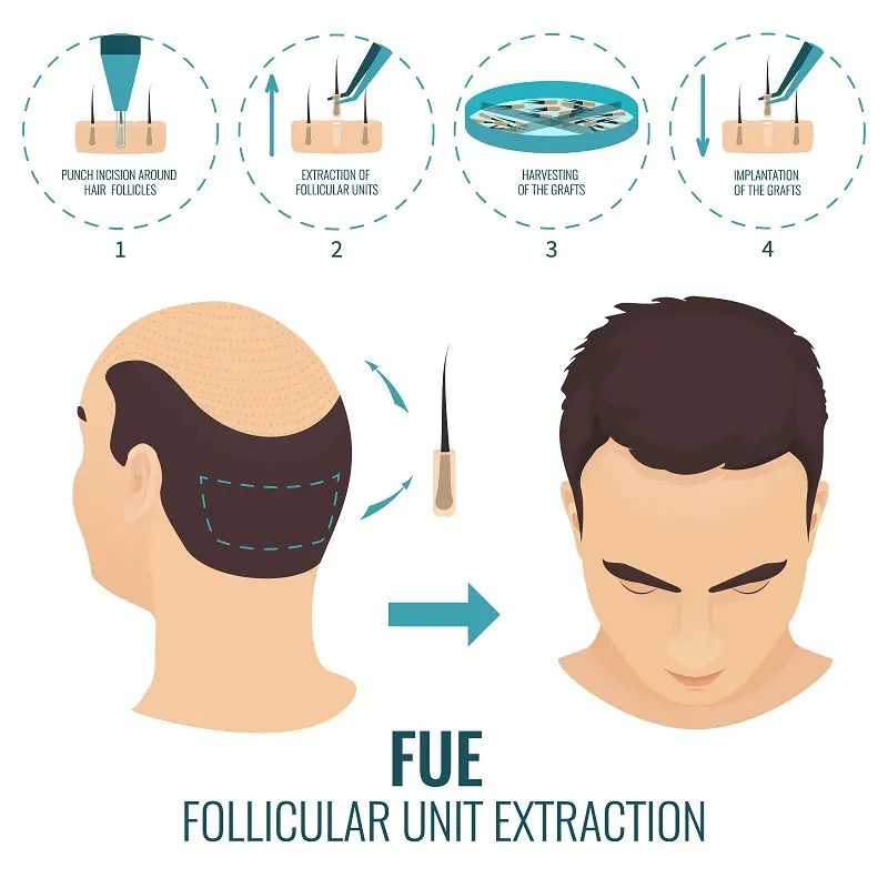 fue-balding