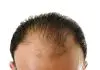 What is Hair transplant, Cost , Advantages and Disadvantages