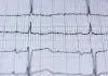 How Radiofrequency Ablation is Used to Treat Atrial Fibrillation: Expert Opinion by Elad Anter, MD