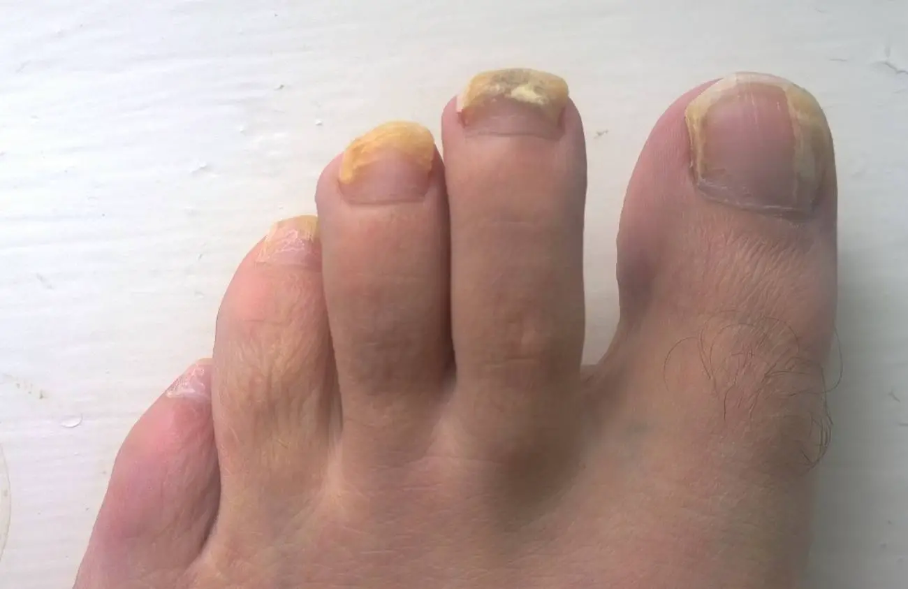 nail fungus fertőző betegség