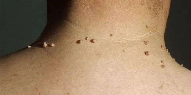 multiple skin tags on neck