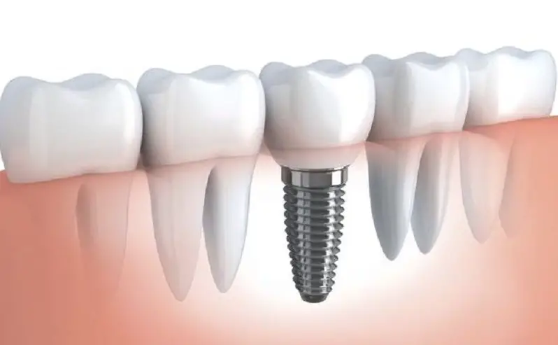 tooth-implant